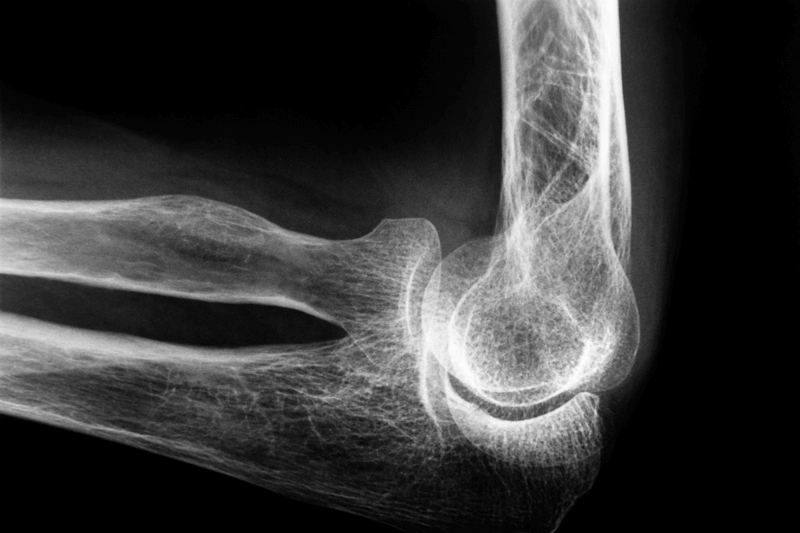 elbow sprain xray